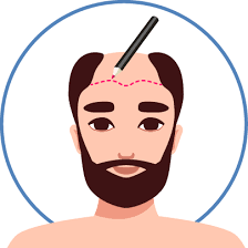 FUE hair transplant method offered by Profue Antalya